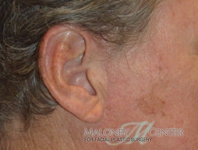After Image: Earlobe Repair - right-side
