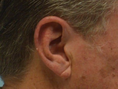 Before Image: Earlobe Repair - right-side