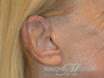After Image: Earlobe Repair - right-side