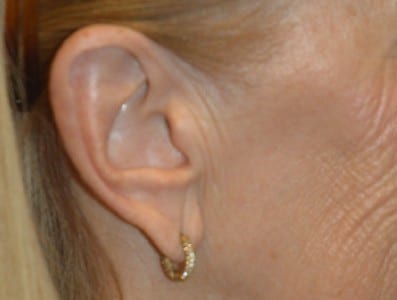 Before Image: Earlobe Repair - right-side