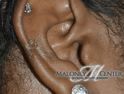 After Image: Earlobe Repair - right-side
