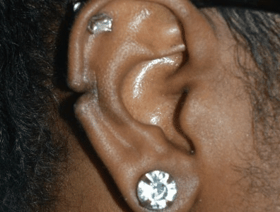 Before Image: Earlobe Repair - right-side