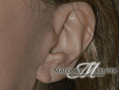 After Image: Earlobe Repair - left-side