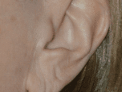 Before Image: Earlobe Repair - left-side
