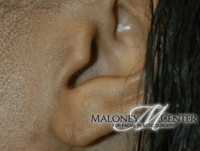 After Image: Earlobe Repair - left-side