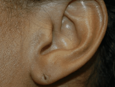 Before Image: Earlobe Repair - left-side