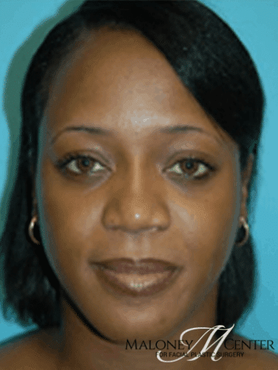 After Image: Ethnic Rhinoplasty - front