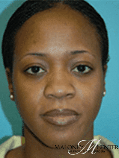 Before Image: Ethnic Rhinoplasty - front