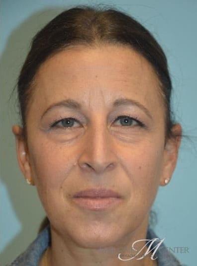 After Image: Eyelid Surgery - front
