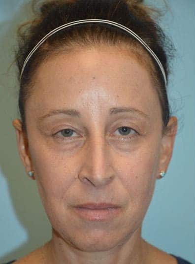 Before Image: Eyelid Surgery - front