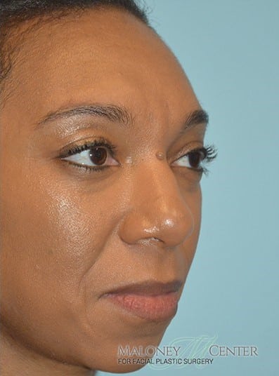 After Image: Eyelid Surgery - right-front-oblique