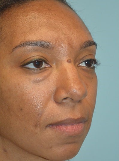 Before Image: Eyelid Surgery - right-front-oblique