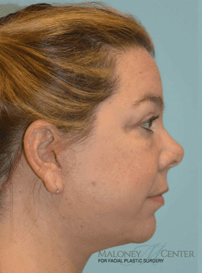 After Image: Eyelid Surgery - right-side