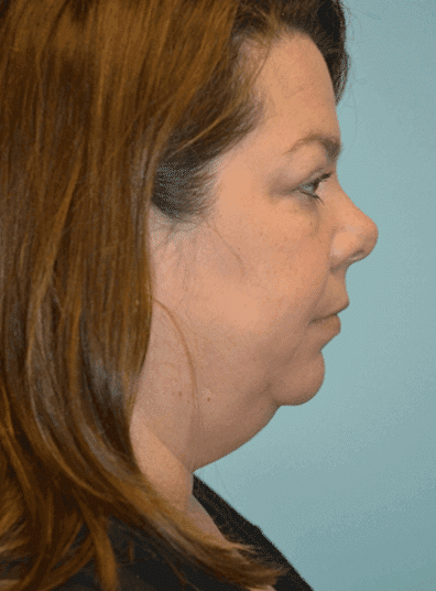 Before Image: Eyelid Surgery - right-side