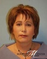 After Image: Eyelid Surgery - front