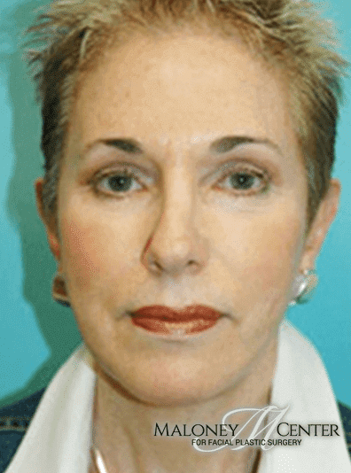 After Image: Eyelid Surgery - front