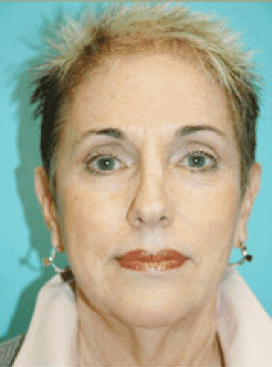 Before Image: Eyelid Surgery - front