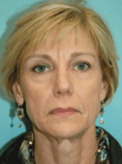 Before Image: Eyelid Surgery - front