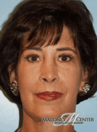 After Image: Eyelid Surgery - front