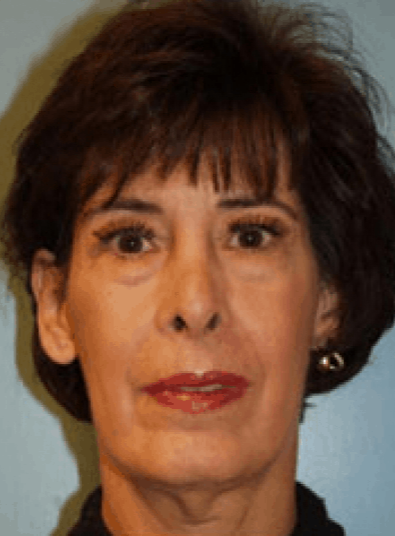 Before Image: Eyelid Surgery - front