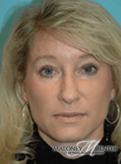 After Image: Eyelid Surgery - front