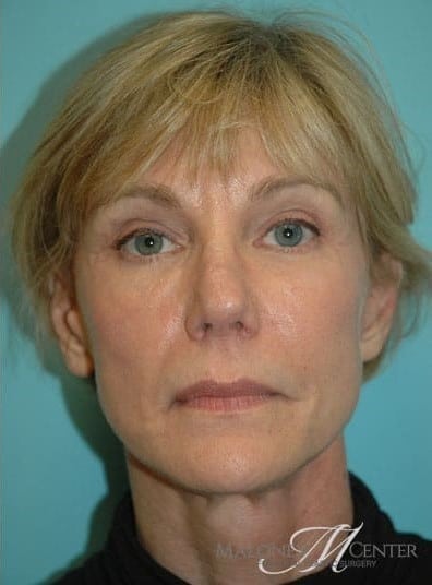 After Image: Eyelid Surgery - front