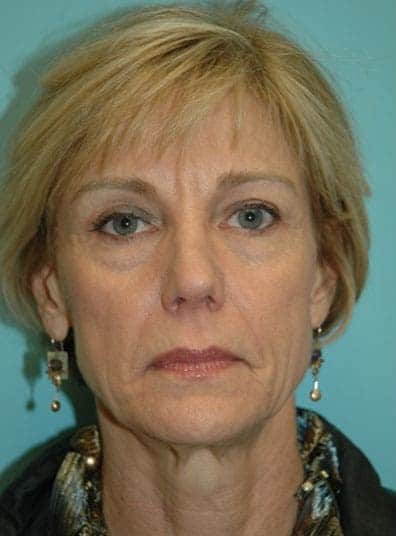 Before Image: Eyelid Surgery - front