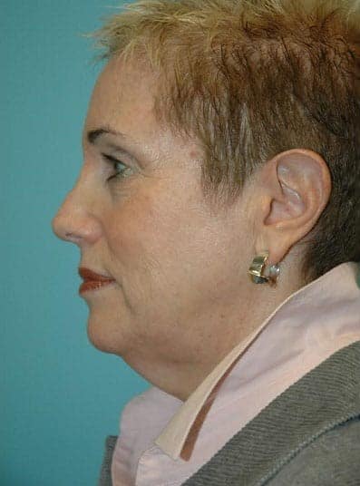 Before Image: Eyelid Surgery - left-side