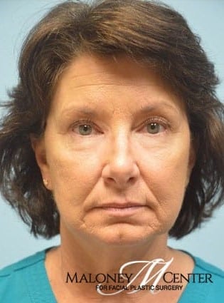 After Image: Eyelid Surgery - front