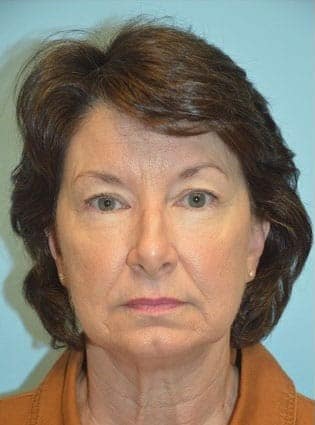 Before Image: Eyelid Surgery - front