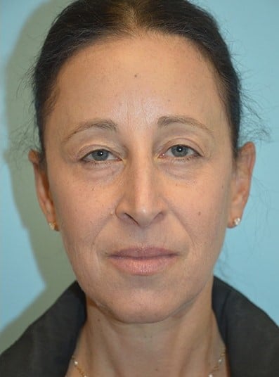 After Image: Eyelid Surgery - front