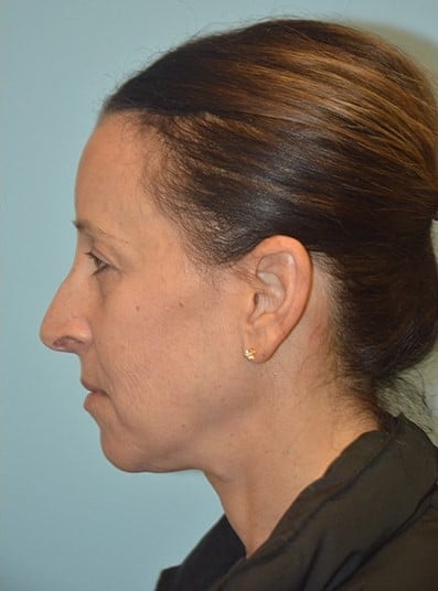 After Image: Eyelid Surgery - left-side
