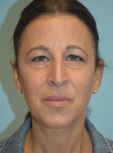 Before Image: Eyelid Surgery - front
