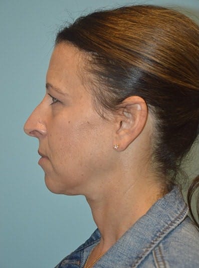 Before Image: Eyelid Surgery - left-side