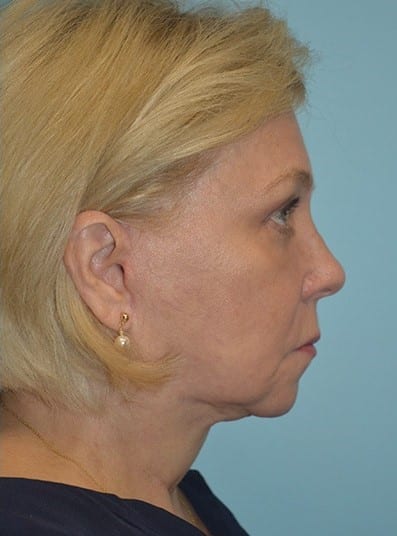 After Image: Eyelid Surgery - right-side