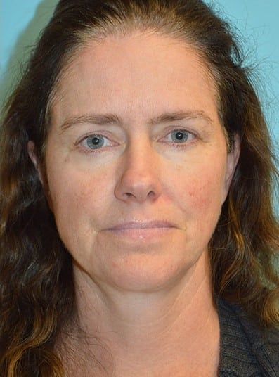 After Image: Eyelid Surgery - front
