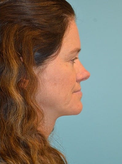 After Image: Eyelid Surgery - right-side