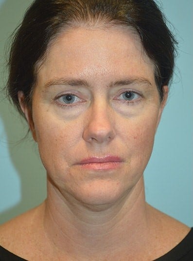 Before Image: Eyelid Surgery - front