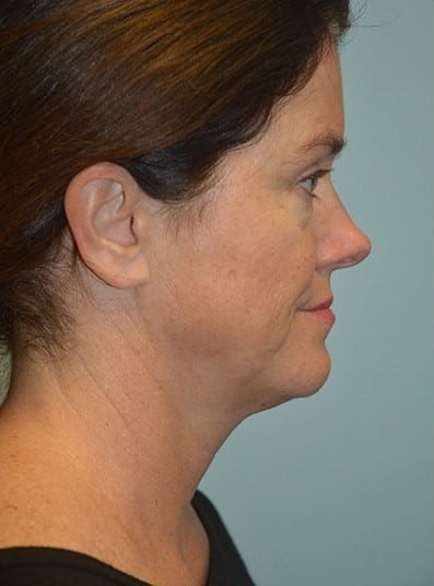 Before Image: Eyelid Surgery - right-side