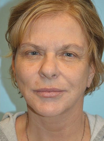 After Image: Eyelid Surgery - front