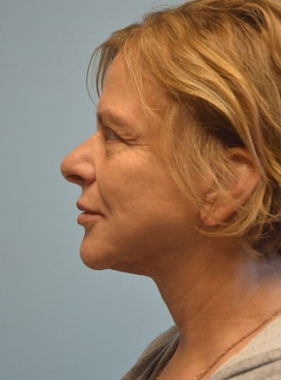 After Image: Eyelid Surgery - left-side