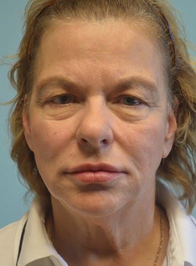 Before Image: Eyelid Surgery - front