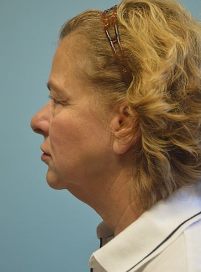 Before Image: Eyelid Surgery - left-side