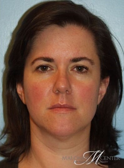 After Image: Eyelid Surgery - front