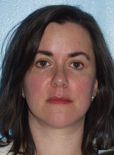 Before Image: Eyelid Surgery - front