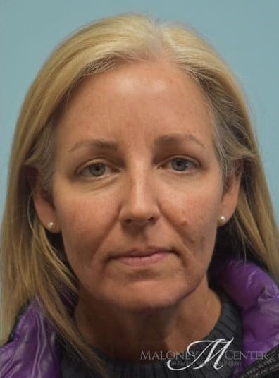After Image: Eyelid Surgery - front
