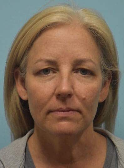 Before Image: Eyelid Surgery - front