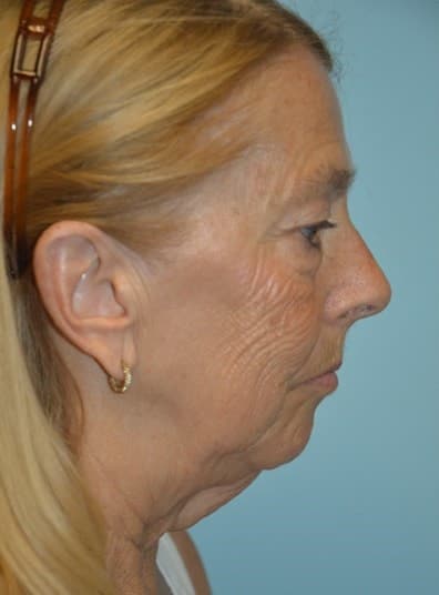 Before Image: Eyelid Surgery - right-side