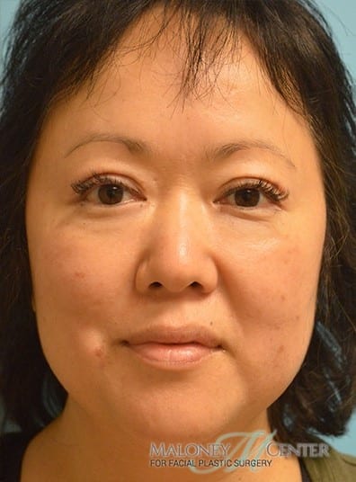 After Image: Eyelid Surgery - front