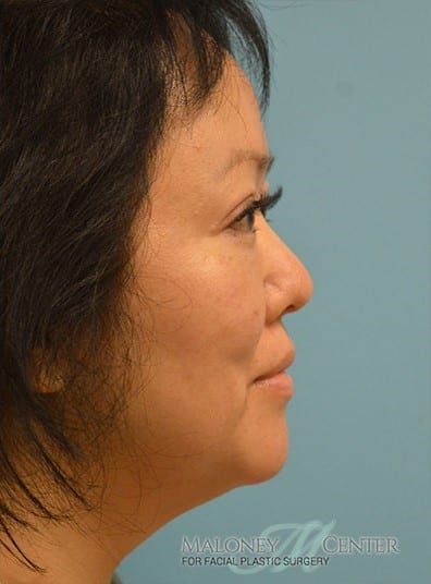 After Image: Eyelid Surgery - right-side
